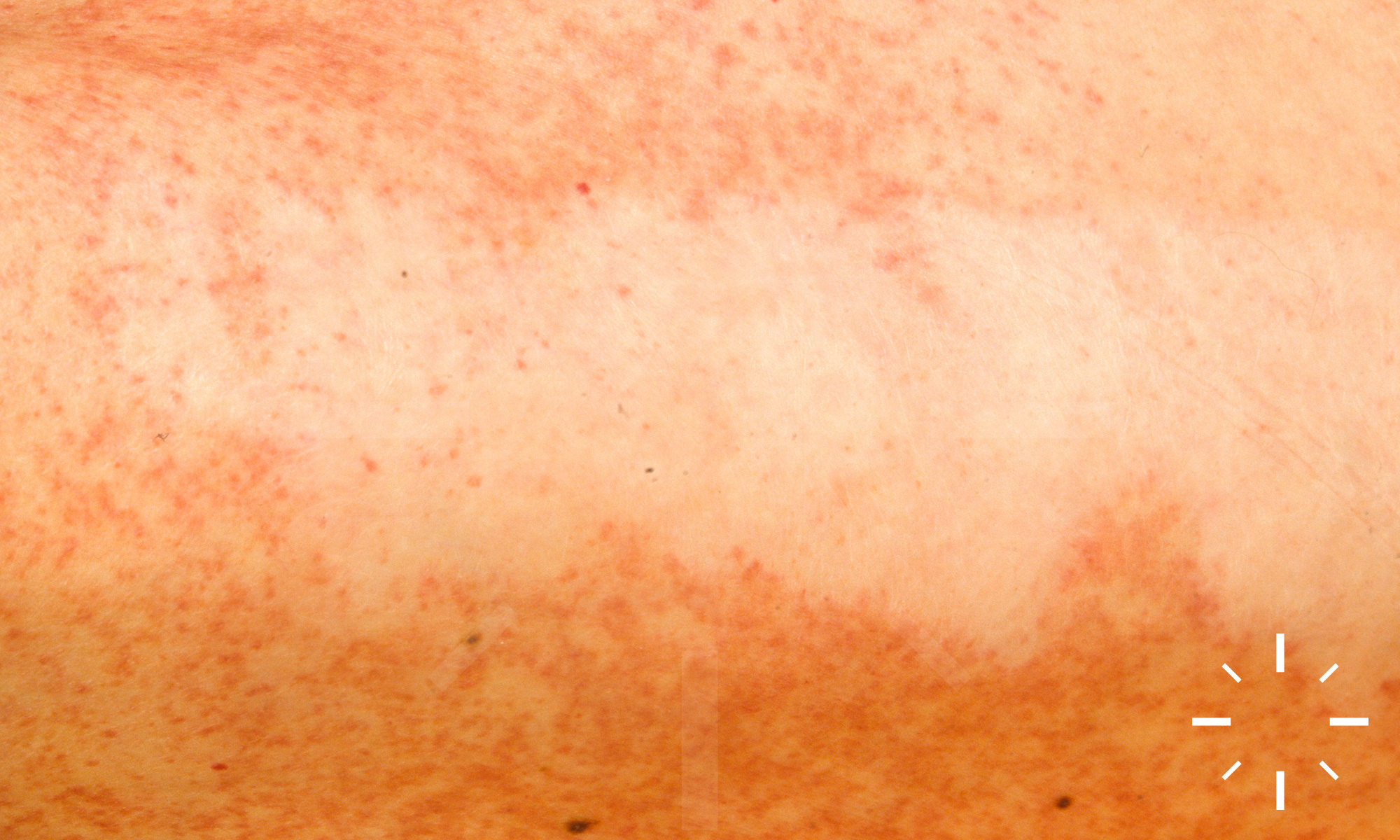Dermacompass Stevens Johnson Syndrome And Toxic Epidermal Necrolysis