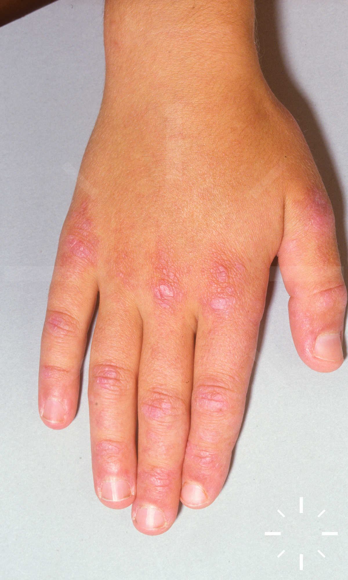 KNV Medpage - (P-235) HISTOPATHOLOGY-152 (7/8/2020) with ANSWER: A girl  younger than 2 years presented with a 7-month history of an inflammatory  plaque on her left index finger (Figure, A). This lesion