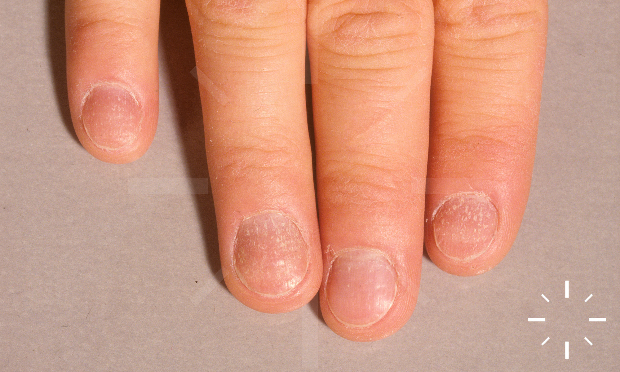 Green nail syndrome - Wikipedia