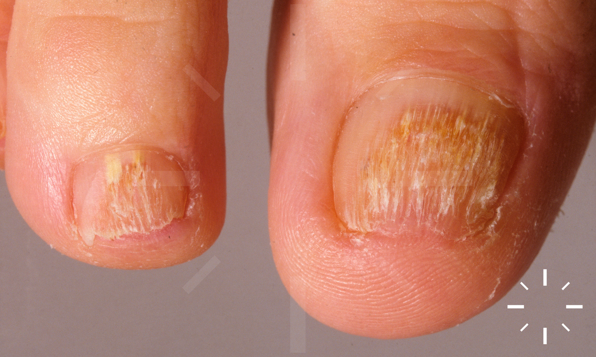 Figure 1 from Treatment of Pseudomonas Nail Infections with 0.1% Octenidine  Dihydrochloride Solution | Semantic Scholar