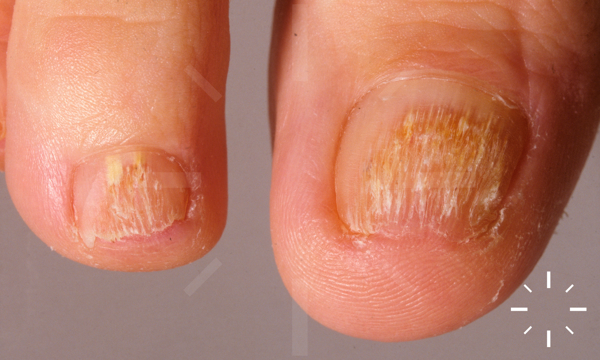 Understanding Fungal Nail Infections and Best Treatment Options