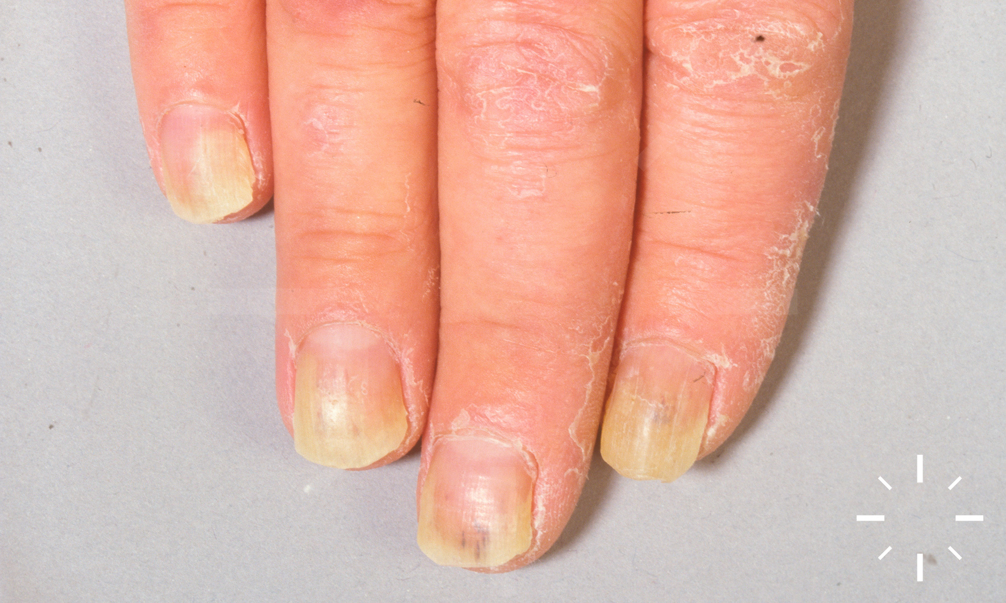 Blue to Slate Gray Discoloration of the Proximal Fingernails | MDedge  Dermatology