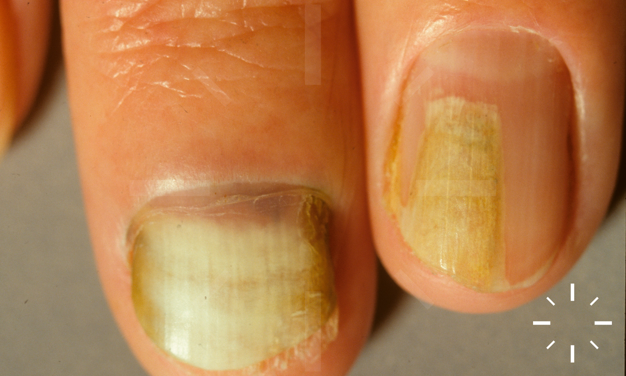 Pseudomonas bacterial nail infection. Close-up of the thumb nail on the  right hand of a 59-year-old woman with green nail syndrome (chloronychia).  Thi Stock Photo - Alamy
