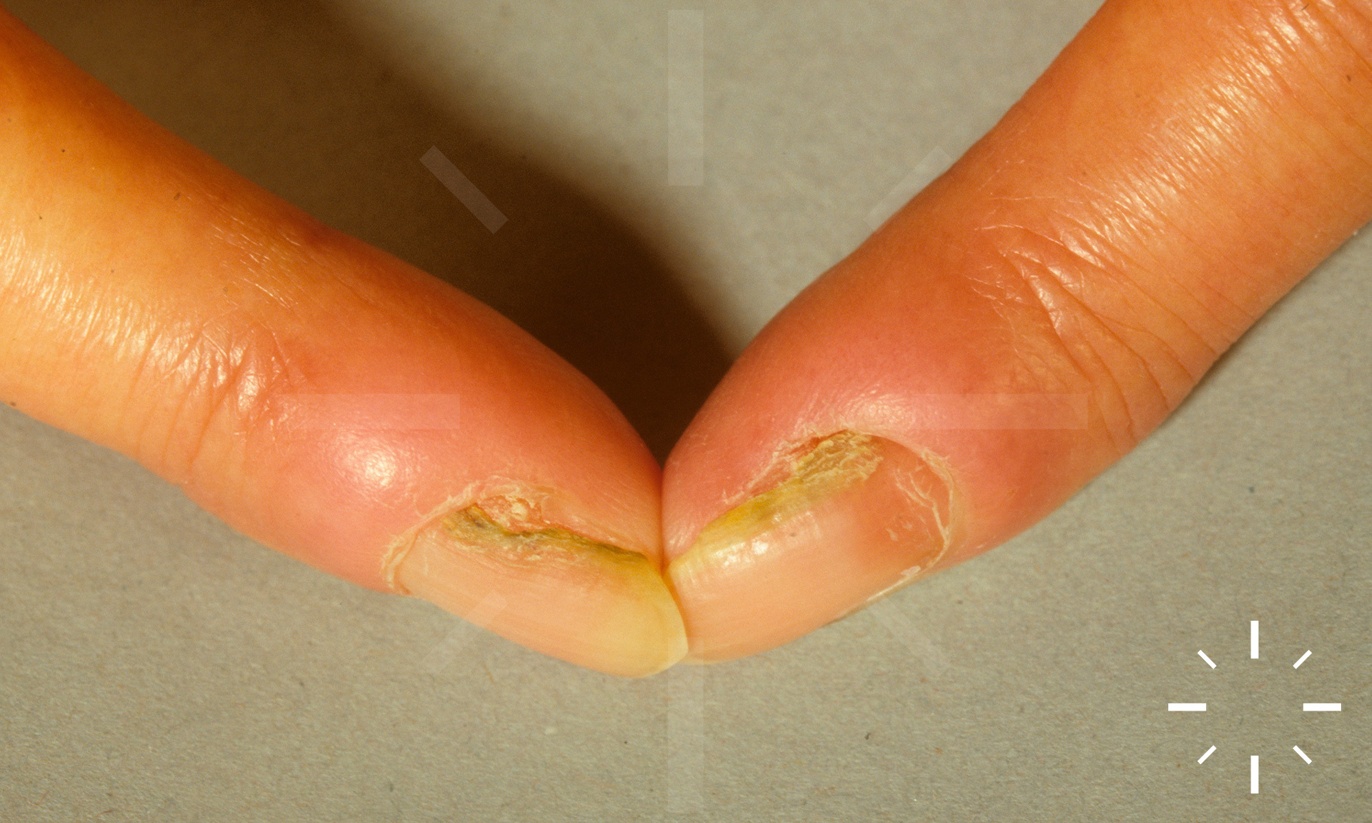 Green discoloration of a dishwasher's fingernail - Clinical Advisor