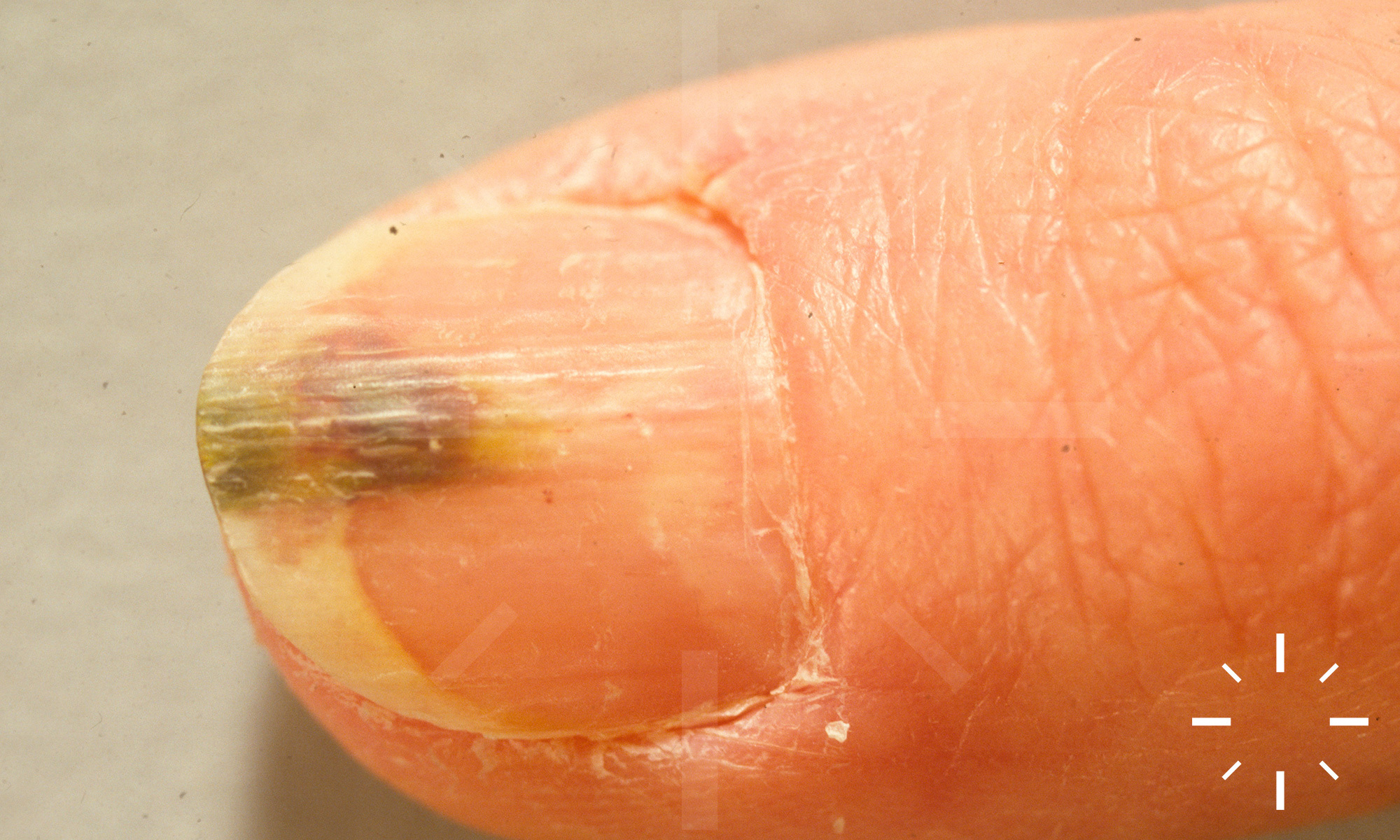 Diseases of Nails | SpringerLink