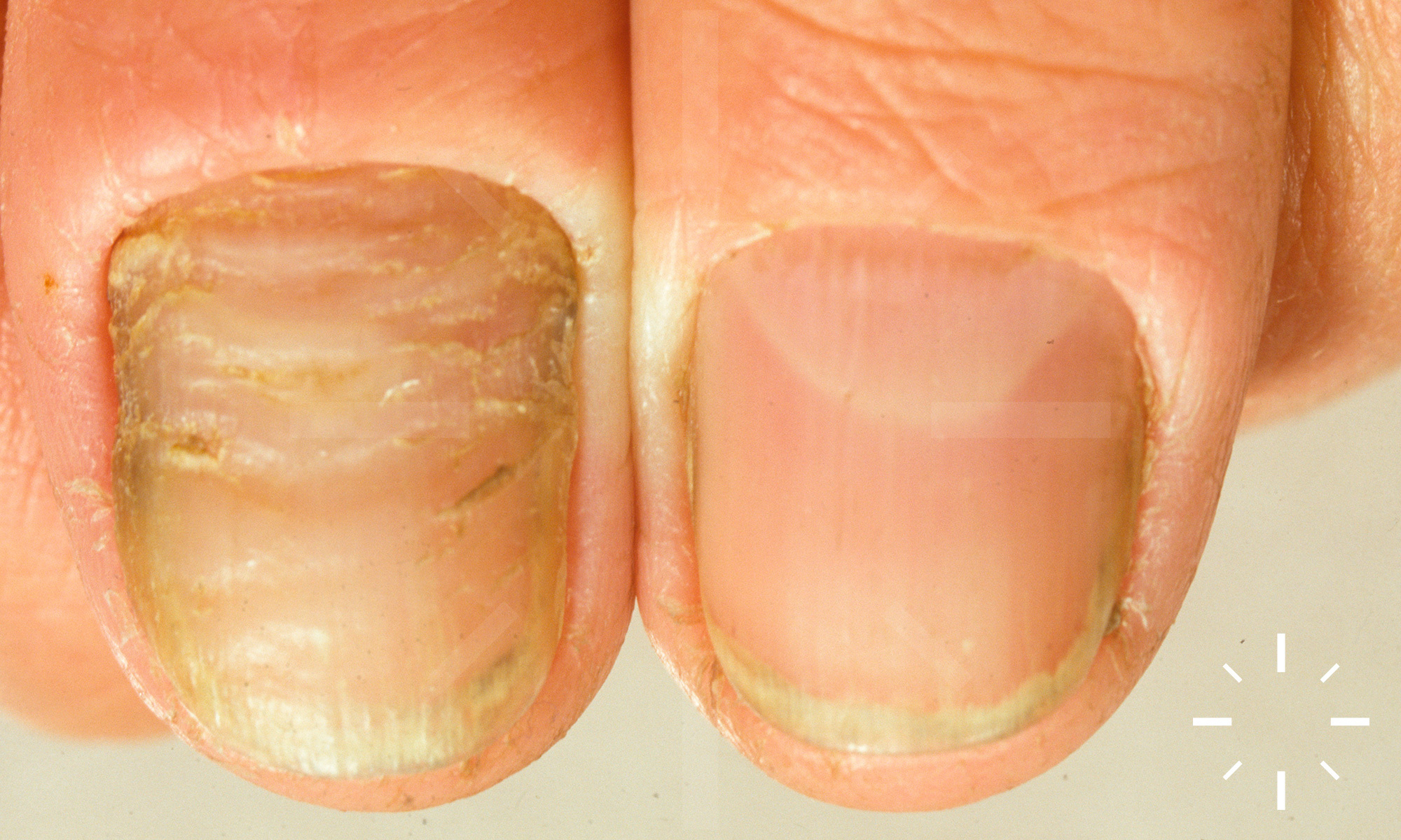 Green Nail Syndrome (Pseudomonas aeruginosa Nail Infection): Two Cases  Successfully Treated with Topical Nadifloxacin, an Acne Medication. -  Abstract - Europe PMC