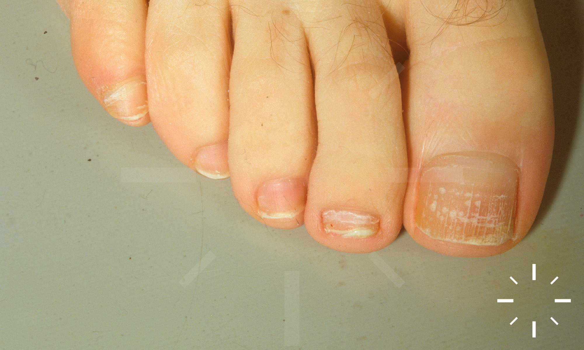 Aladdin Creations - 💥Onychomycosis, also known as tinea unguium