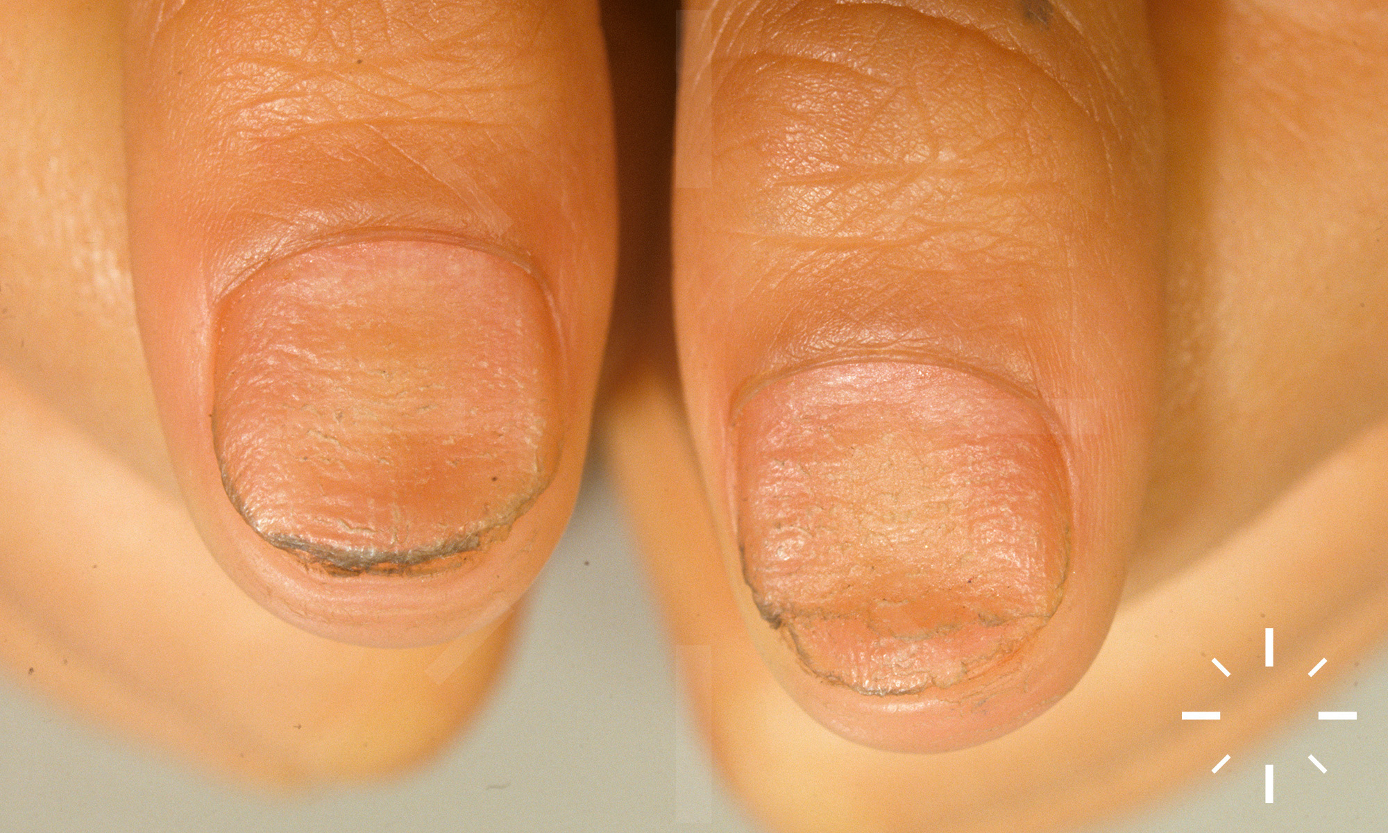 Nail Disorders secondary to Systemic Diseases Nail ... | GrepMed