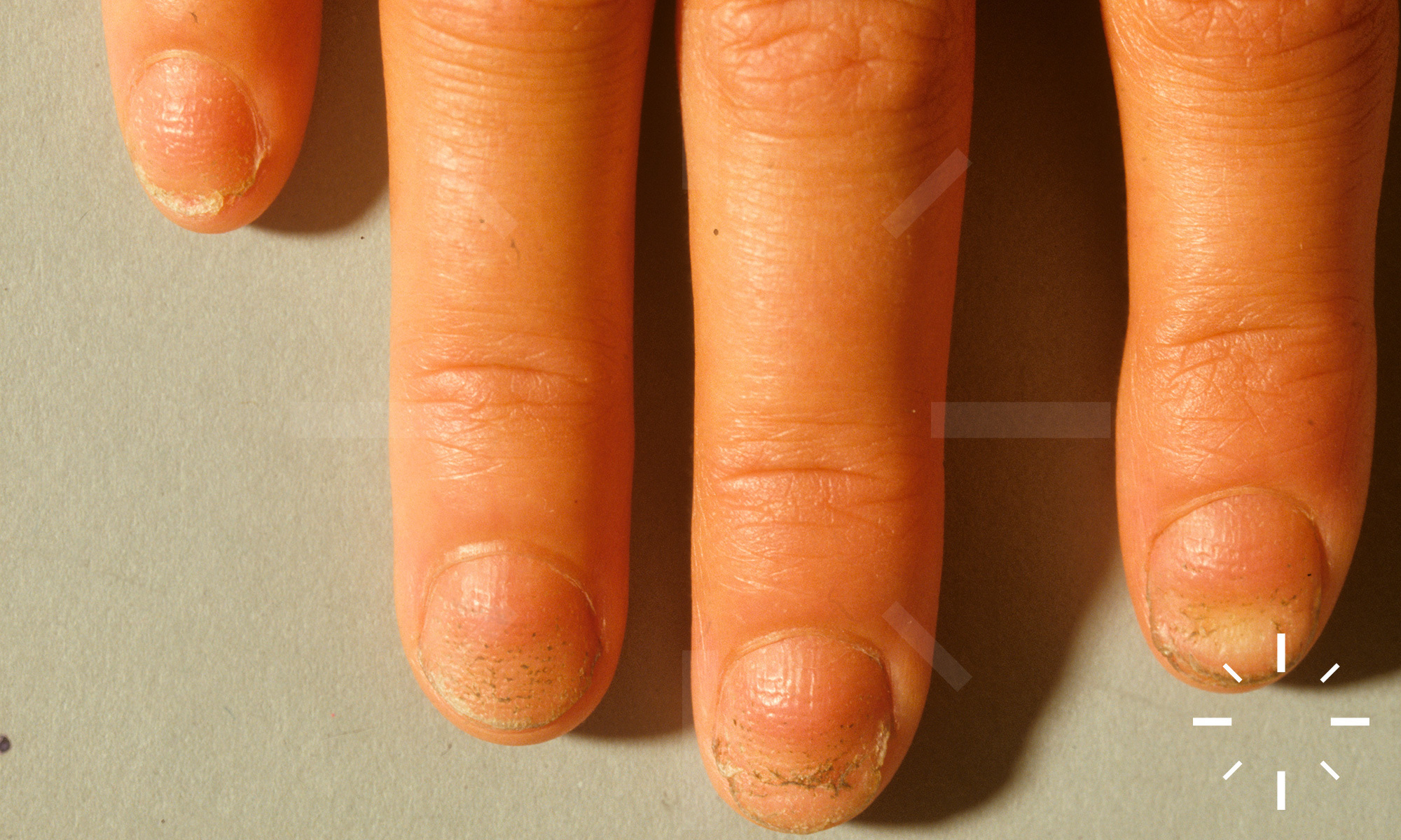 What Your Fingernails Say About Your Health