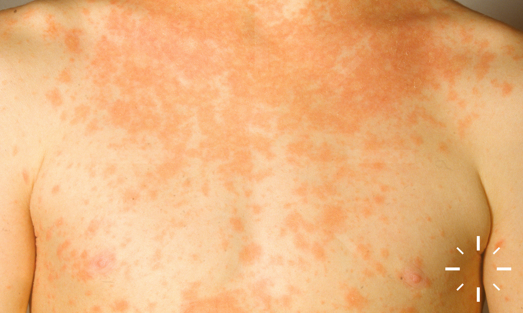 Pityriasis rosea deals