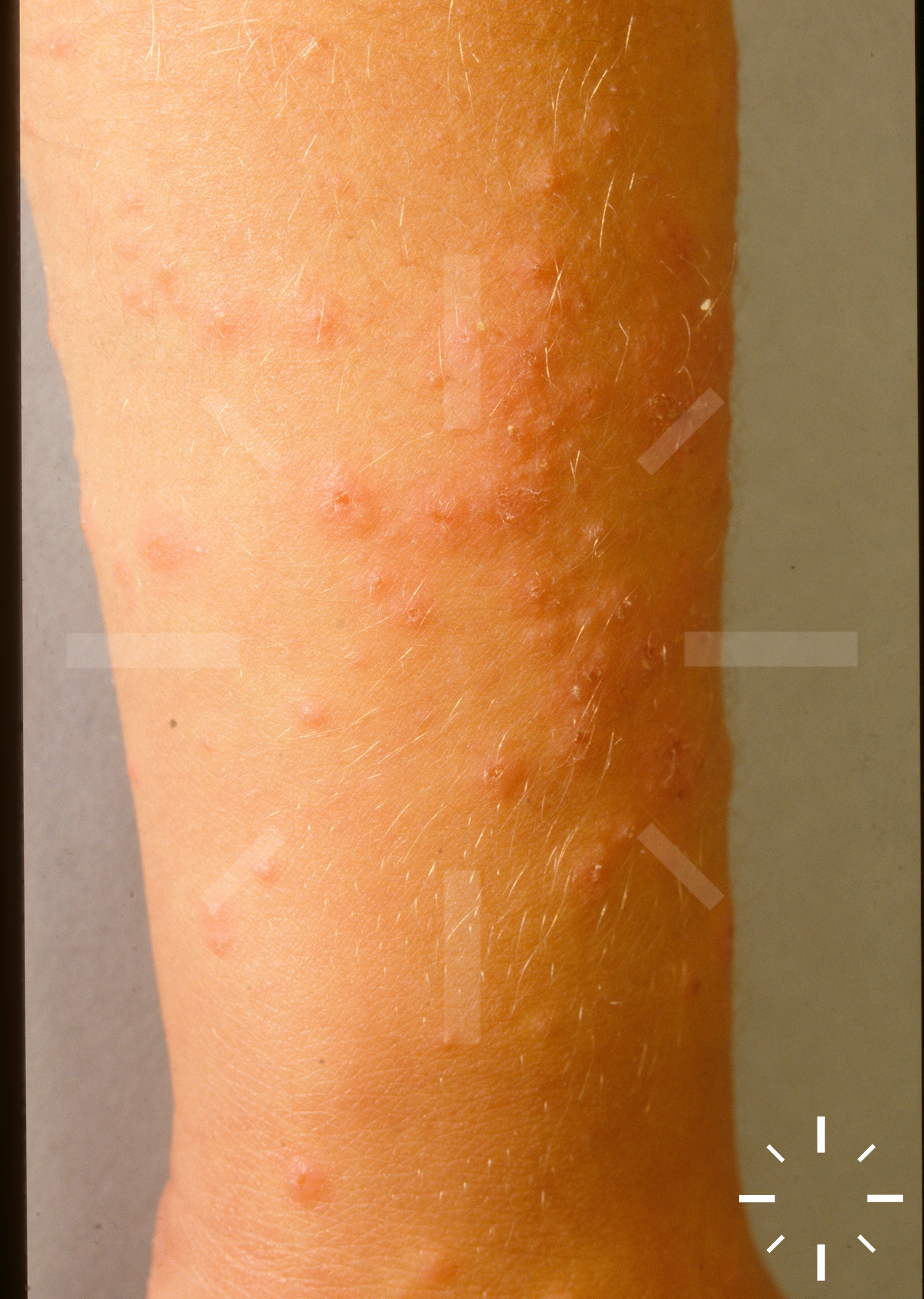 Tinea Corporis