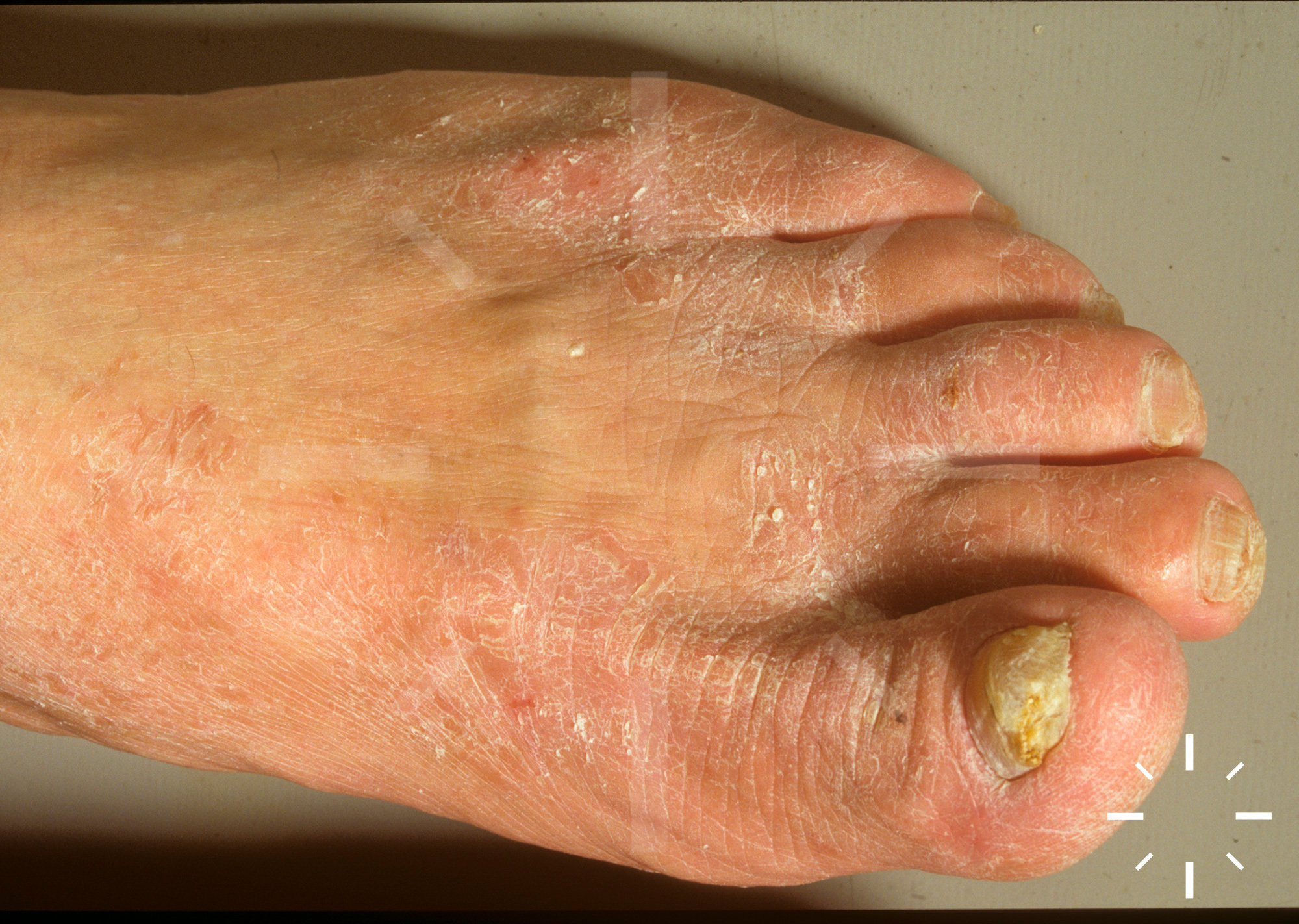 DermaCompass - Tinea pedis