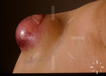 DFSP Shoulder