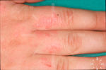 Pityriasis rubra pilaris
