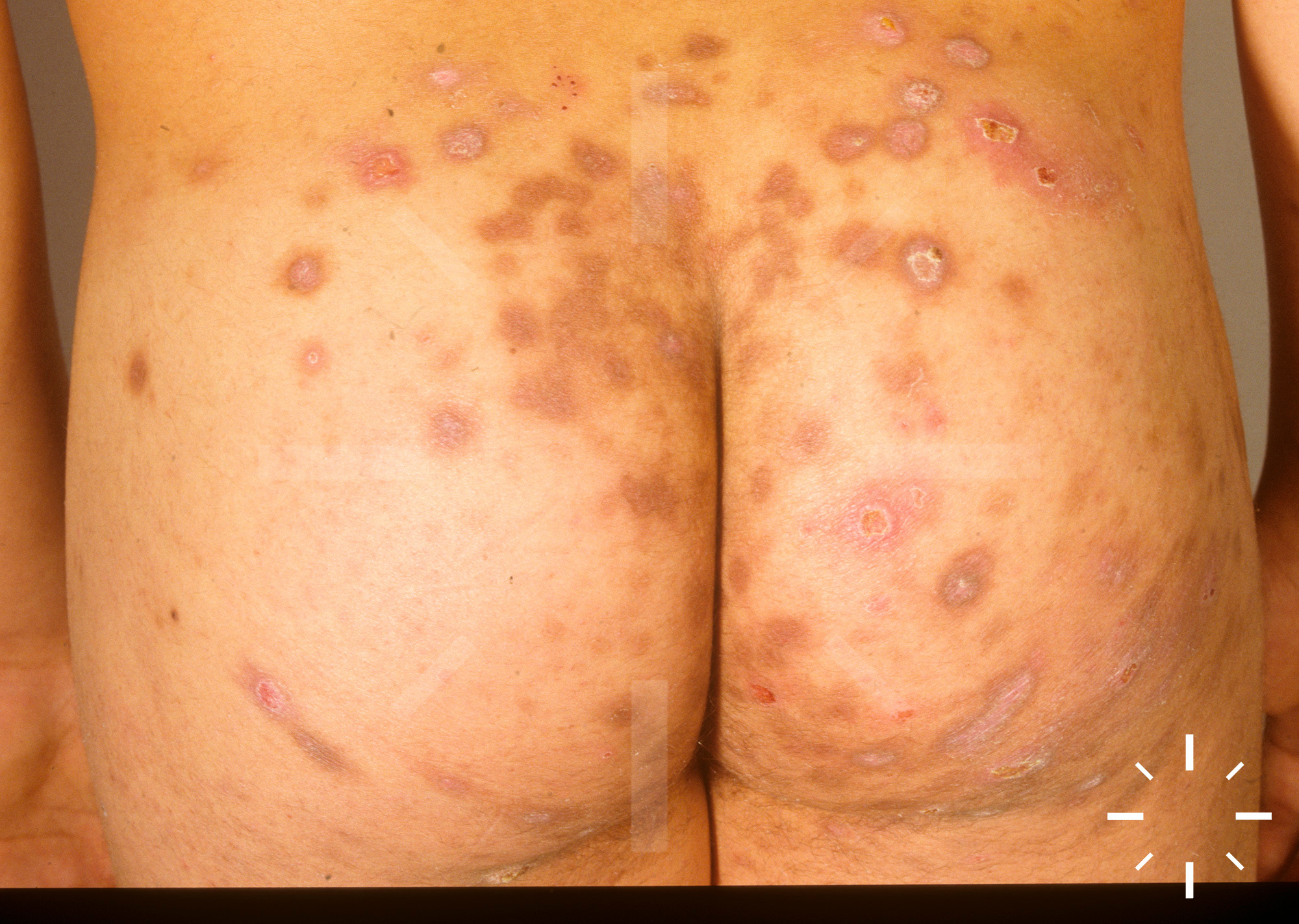 DermaCompass - Tinea corporis (mycosis)