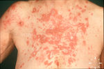 Pityriasis rubra pilaris