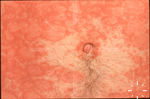 Pityriasis rubra pilaris