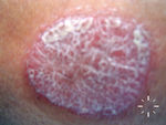 Psoriasis Vulgaris