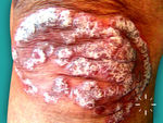 Plaque Psoriasis