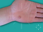 Granuloma pyogenicum
