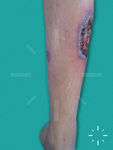 Pyoderma gangrenosum