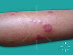 Pyoderma gangrenosum