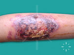 Pyoderma gangrenosum