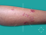 Pyoderma gangrenosum