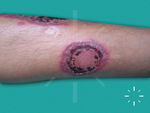 Pyoderma gangrenosum