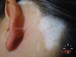 Vitiligo
