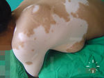 Vitiligo