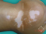 Vitiligo