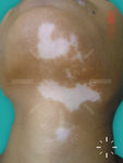 Vitiligo