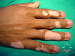 Vitiligo