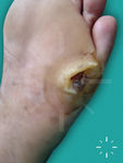 Tropical ulcer