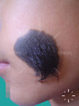 Giant congenital melanocytic naevus