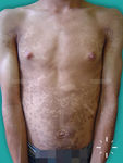 Pityriasis versicolor