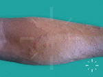 Tinea corporis