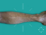 Tinea corporis