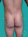 Tinea glutealis/corporis