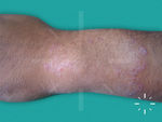 Tinea corporis