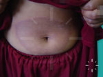 Tinea corporis